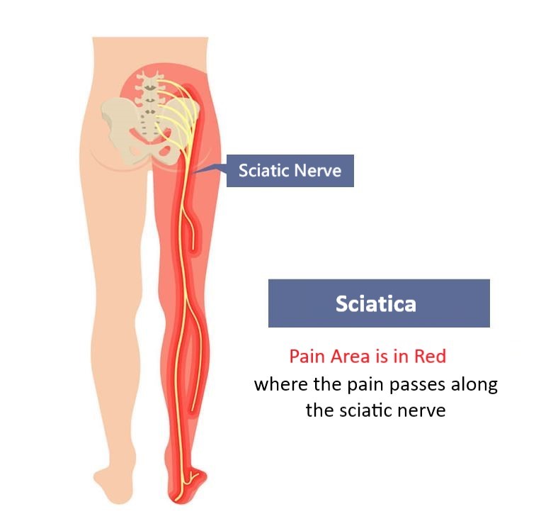 What is Sciatica? HKBSSP