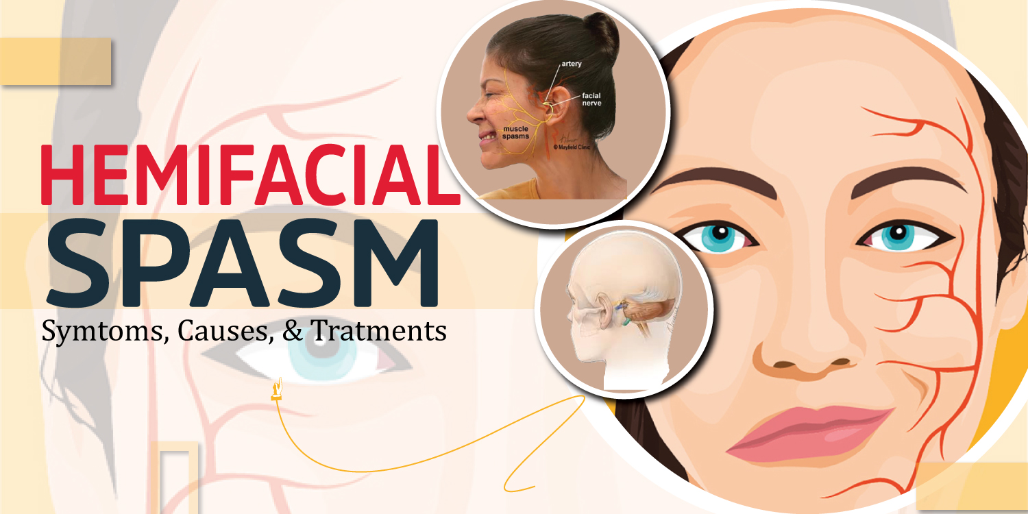 Hemifacial Spasm: Symptoms, Causes, and Treatments