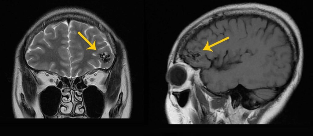 Hemorrhagic Stroke 2