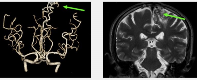 三維立體腦血管造影顯示左邊大腦都有先天性的腦血管動靜脈畸
