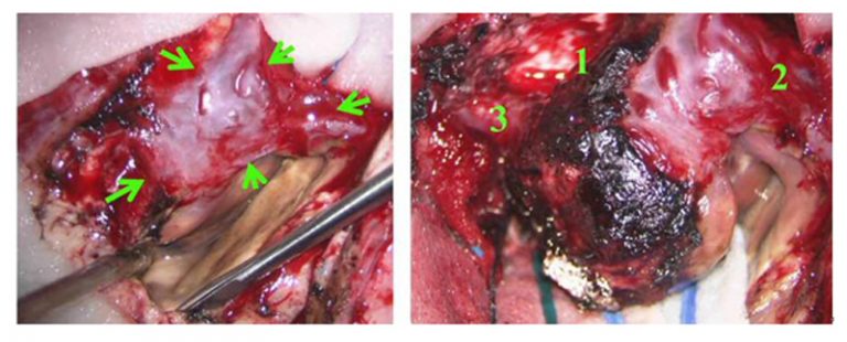 清除血塊後，在顯微鏡下切除腦先天性動靜脈畸形血管