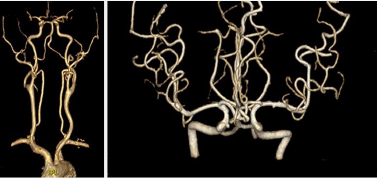 身體檢查的三維立體腦血管造影篩查