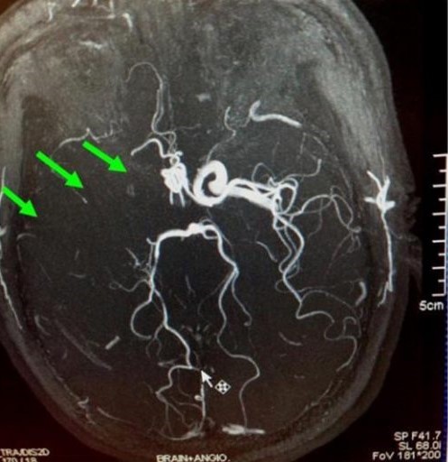 缺血性中風-急救-手術治療-個案-腦血管外科2