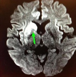 右邊大腦缺血水腫，導致左邊手腳無力和神智半昏迷。