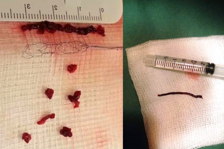 導管遊走到病人右邊的頸和腦部血管大動脈，進行機械式血栓吸取