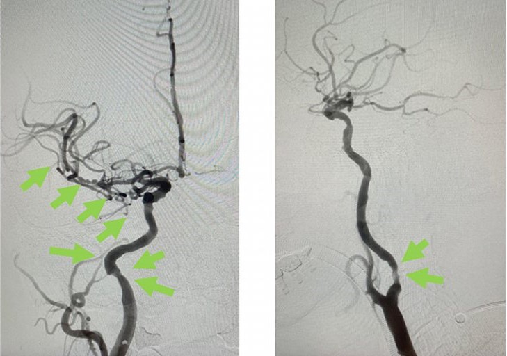 血栓被吸取後, 右頸和腦血管都給順利打通，腦部缺血情況立即得到改善。