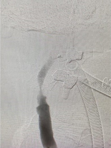 血栓被吸取後，發現右頸內動脈血管嚴重狹窄是中風的主要原因。