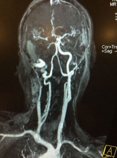 缺血性中風-急救-手術治療-個案-腦血管外科