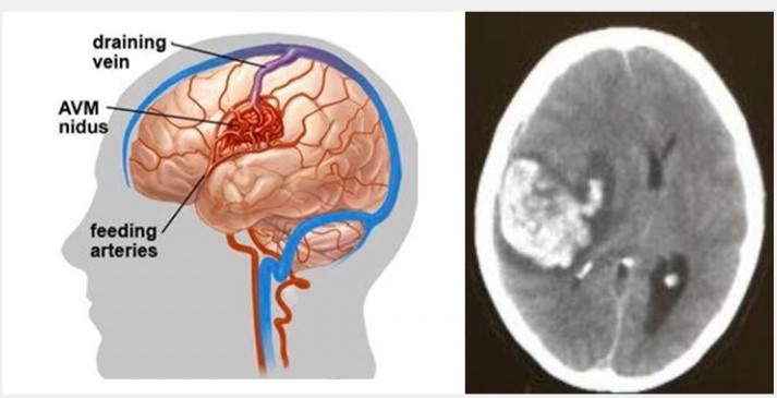 先天性大腦動靜脈畸形血管瘤爆破而引致的嚴重出血性中風