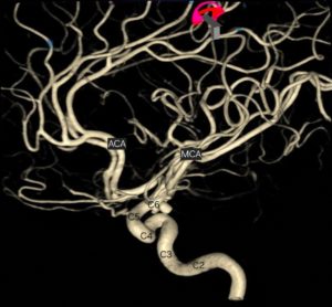 3D MRA to detect narrowed brain vessels in causing acute ischemic stroke