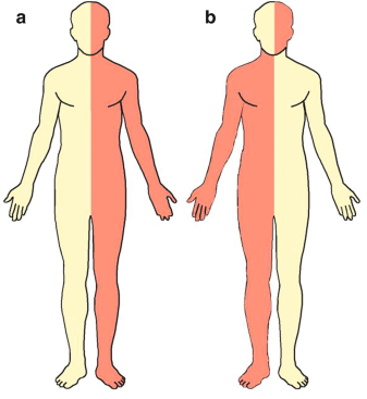 Sudden weakness on one side of the face, arm, or leg (hemiparesis or hemiplegia)