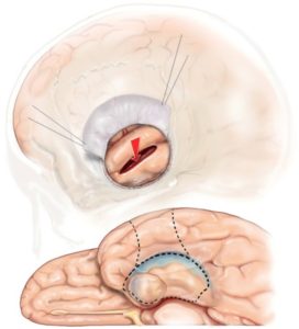 選擇性杏仁核海馬切除術