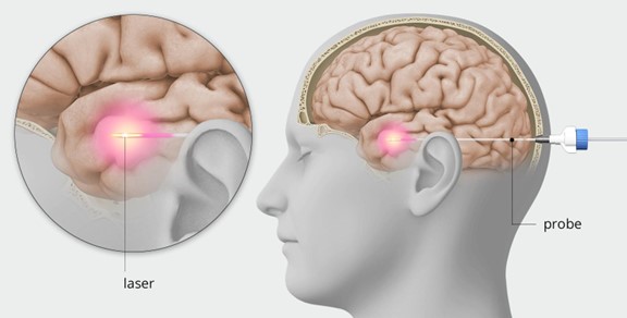 雷射間質熱療 (LITT)