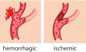 Bleeding in hemorrhagic stroke, vessel blockage in ischemic stroke