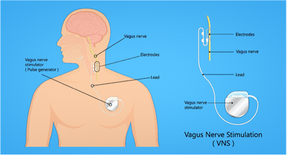 Vagus-Nerve-Stimulation