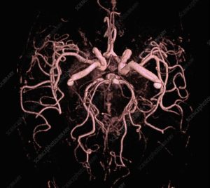 3D MR Angiogram of Brain to detect cerebral aneurysms at both sides
