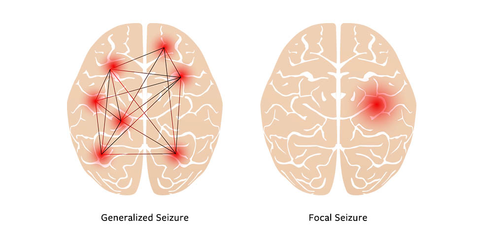 identifying-seizures