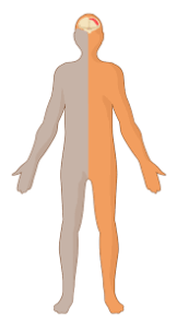 Weakness at one sided limbs (Hemiparesis)