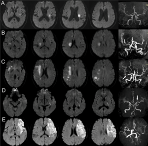 MRI to detect acute ischemic stroke at multiple sites of the brain with Golden Hours